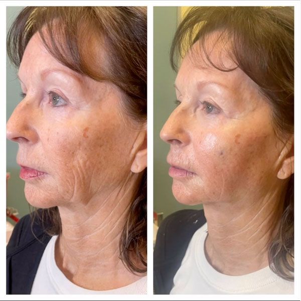 Side-by-side profile photos of a woman before and after facial skin treatment.