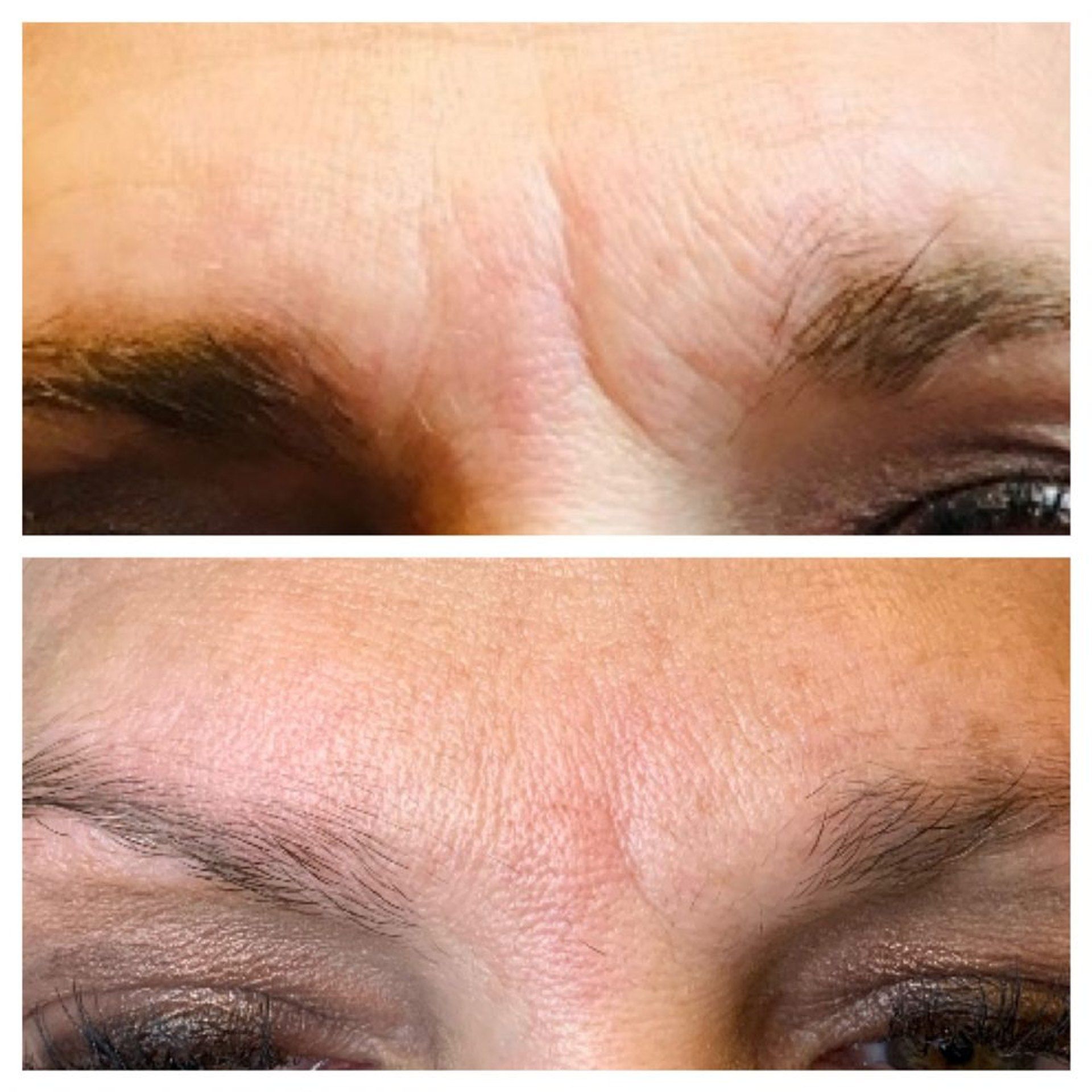 Close-up of lower cheek with three pink microneedling rollers attached to the skin