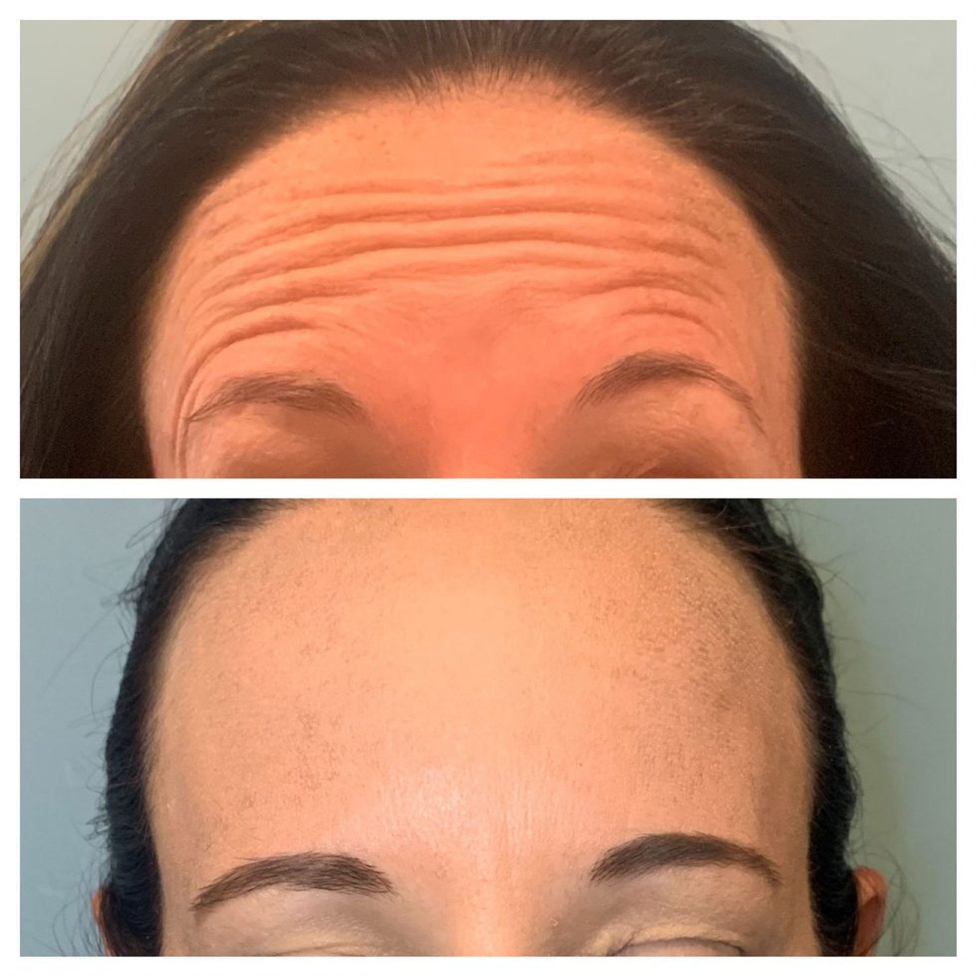 Before-and-after forehead close-up showing horizontal wrinkles reduced after botox treatment
