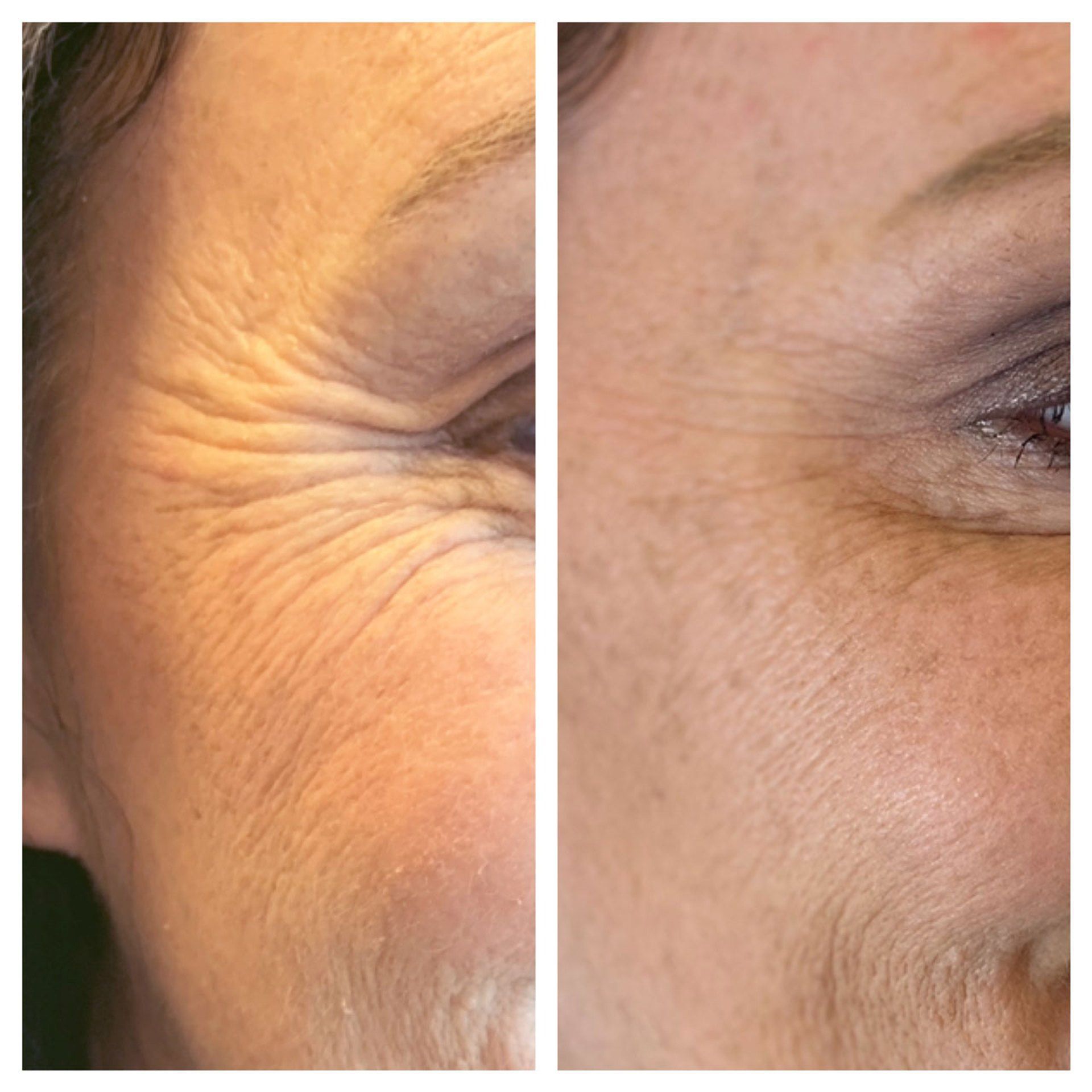 Side-by-side close-up of an eye area showing wrinkled skin before and after treatment.