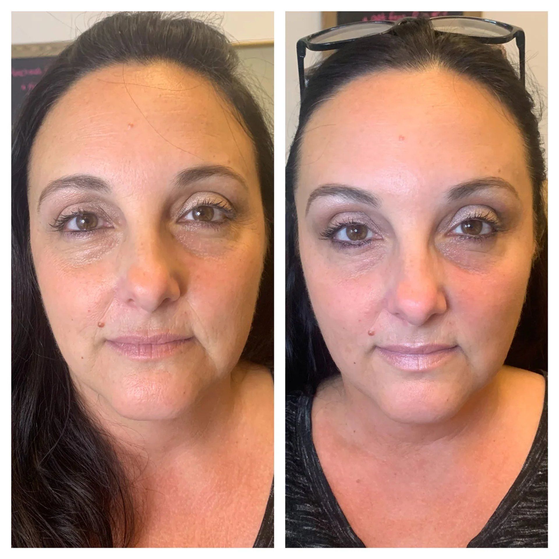 Side-by-side close-up portraits of the same woman with before and after PDO thread lift