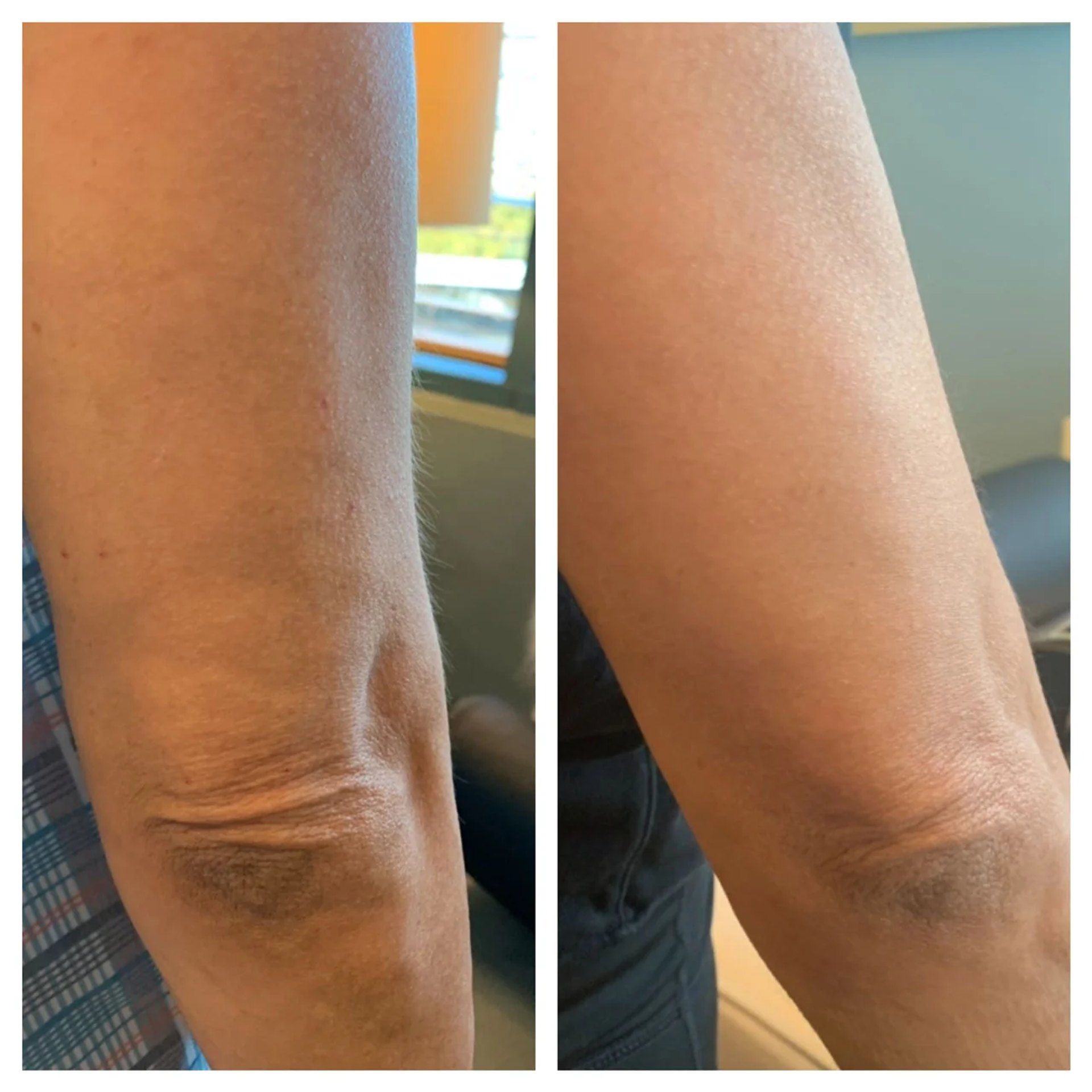 Close-up of an elbow from two angles, showing dry, wrinkled skin. Before and after PDO Thread lift