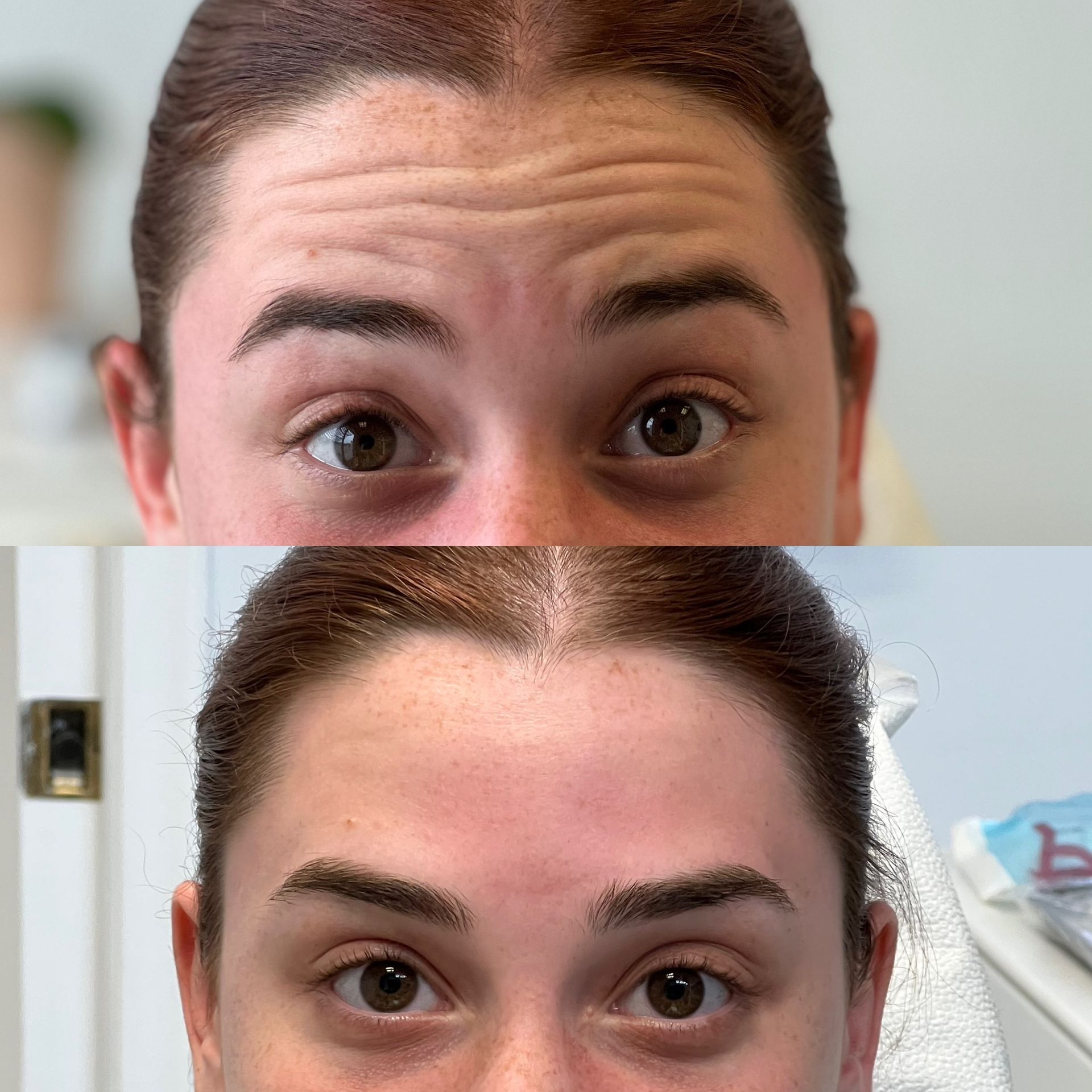 A before and after photo of a woman 's forehead.