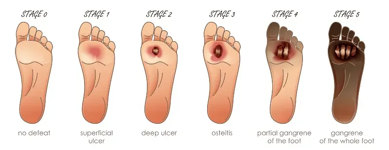 Chart showing stages of foot pressure sores, from no ulcer to black necrotic heel ulcer.
