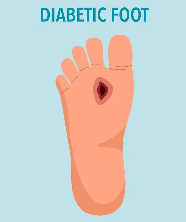 Diagram of a foot with a diabetic ulcer, labeled “DIABETIC FOOT”