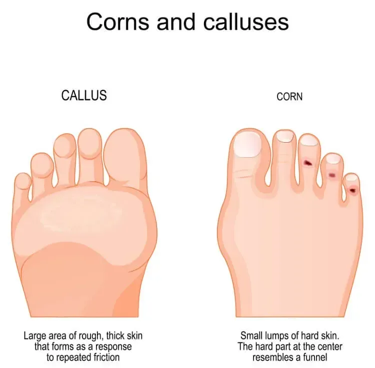 Diagram comparing callus and corn on feet, showing large skin thickening on the sole and small hard toe spots