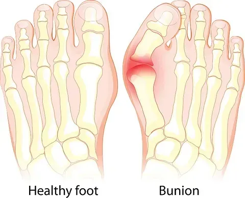 Diagram comparing a healthy foot and a bunion, with the bunion area highlighted in red.