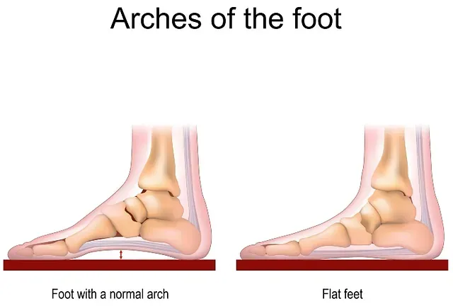 Diagram comparing a normal arch foot and a flat foot side by side