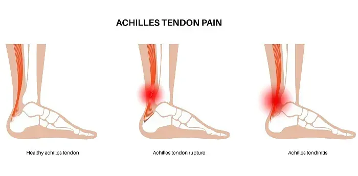 Diagram of Achilles tendon pain: healthy tendon, Achilles tendon symptoms, and posterior ankle with red pain areas
