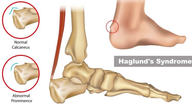 Medical diagram of foot bones highlighting Haglund’s syndrome and heel prominence