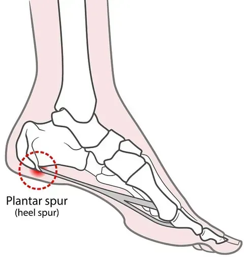 Foot diagram showing a red-circled plantar spur on the heel.