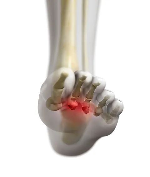 Foot bones highlighted in red, indicating pain in the forefoot near the toes.