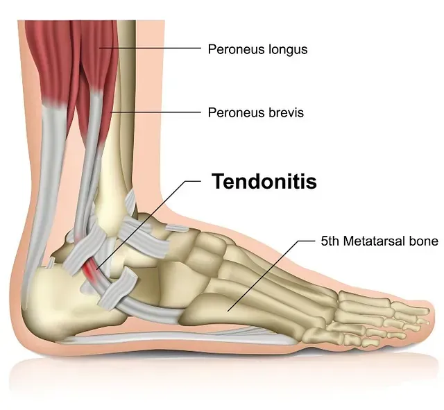 Foot and ankle anatomy diagram highlighting peroneus tendons and tendonitis near the fifth metatarsal