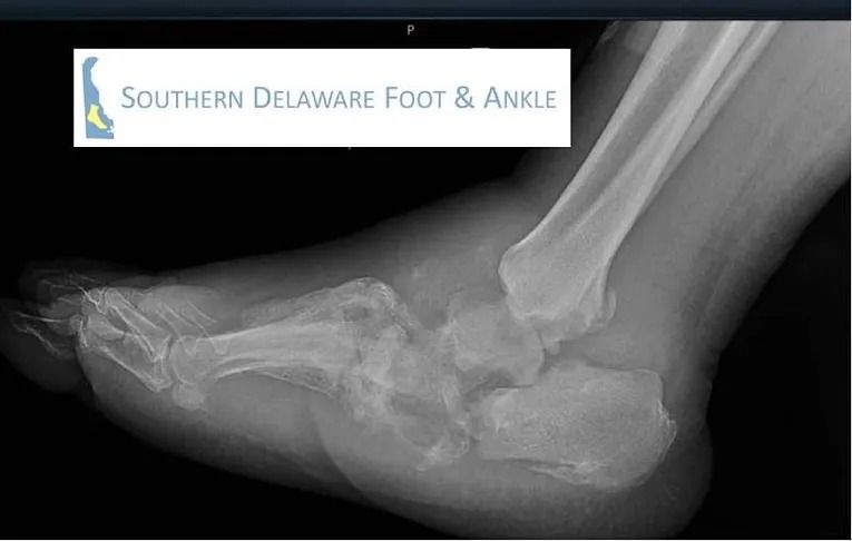 Foot X-ray showing severe deformity; Southern Delaware Foot & Ankle logo in corner