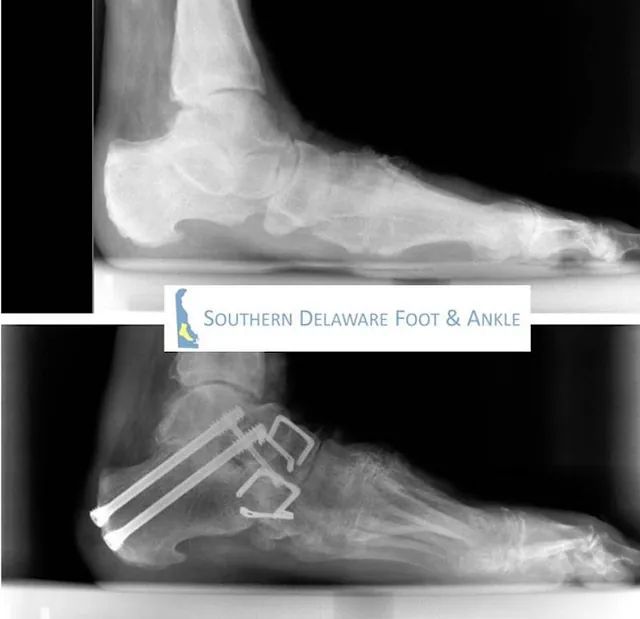X-ray of a foot and ankle with surgical hardware in the heel