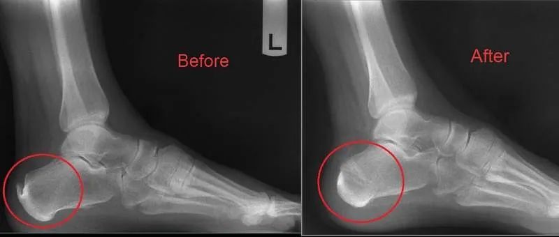 Side-by-side foot X-rays labeled Before and After, with red circles highlighting the heel area.