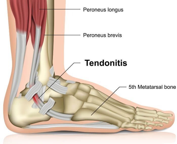 Side-view foot anatomy diagram showing peroneal tendons and tendonitis near the 5th metatarsal bone.