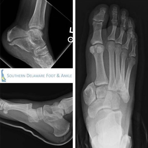 Foot X-rays showing side, front, and oblique views with heel bone fracture.