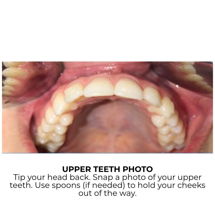 Upper Bite Example