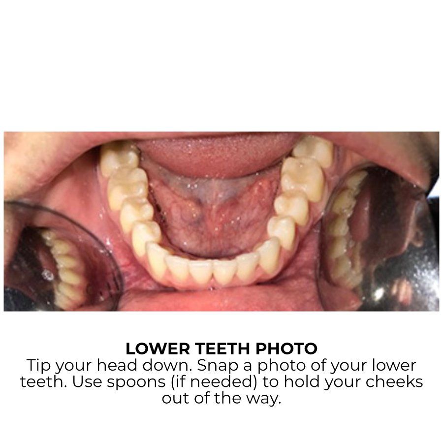 Lower Bite Example