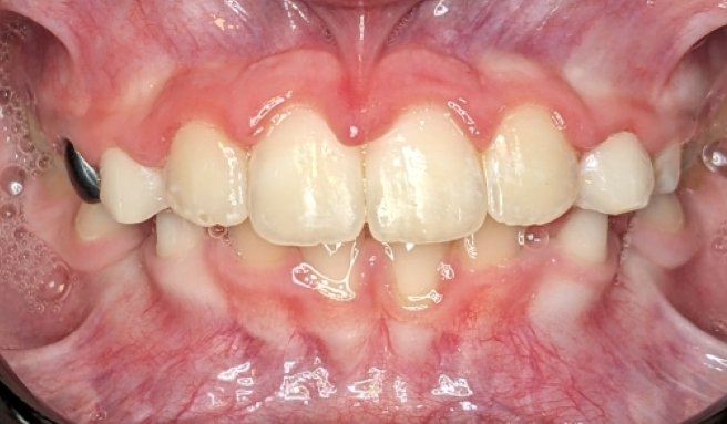 A close-up of a mouth showing significant dental crowding, misaligned teeth, and inflammation of the gum tissue.