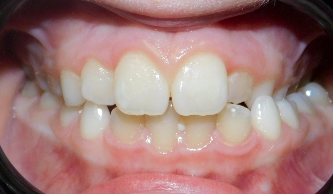 A close-up view of a person's teeth showing dental crowding and a malocclusion with misaligned upper and lower arches.