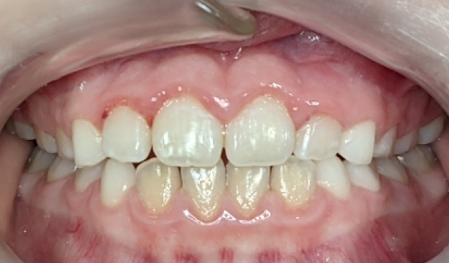 A close-up view of upper and lower teeth, showing healthy gums and a slight misalignment in the lower front teeth.