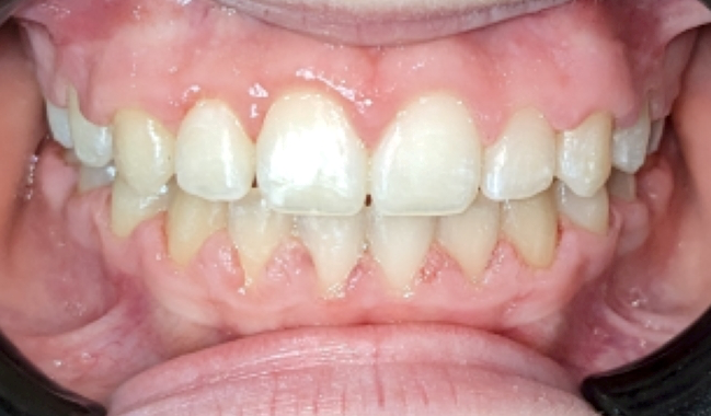 A close-up view of a person's upper and lower teeth, showing signs of gum inflammation, redness, and recession.
