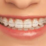 Ceramic Braces