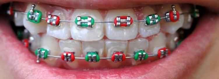 braces with red and green rubber bands for Christmas
