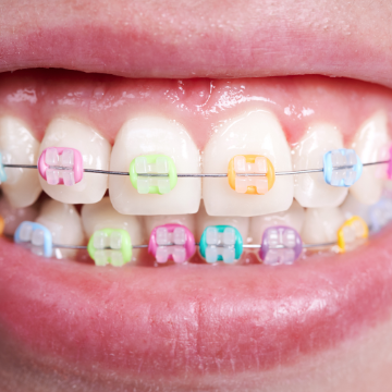 Cool Colors for Cool Smiles: Putting the Fun in Braces Treatment