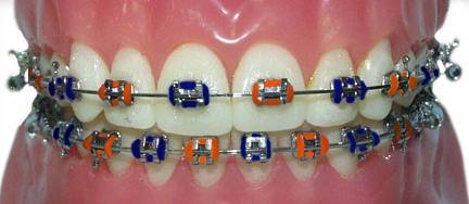 braces with orange and blue rubber bands for the Auburn Tigers