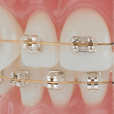 Gold Braces