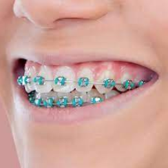 Traditional Metal Braces
