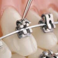 Self-Ligating Braces