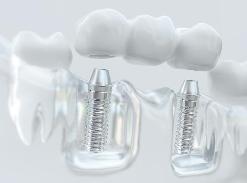 Implant-Supported Bridge
