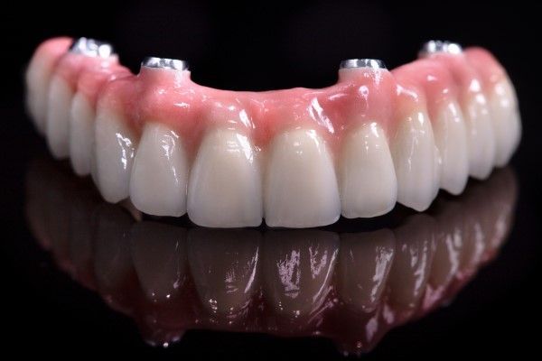 Ask a Dentist: What Do I Need to Know About All-on-4?
