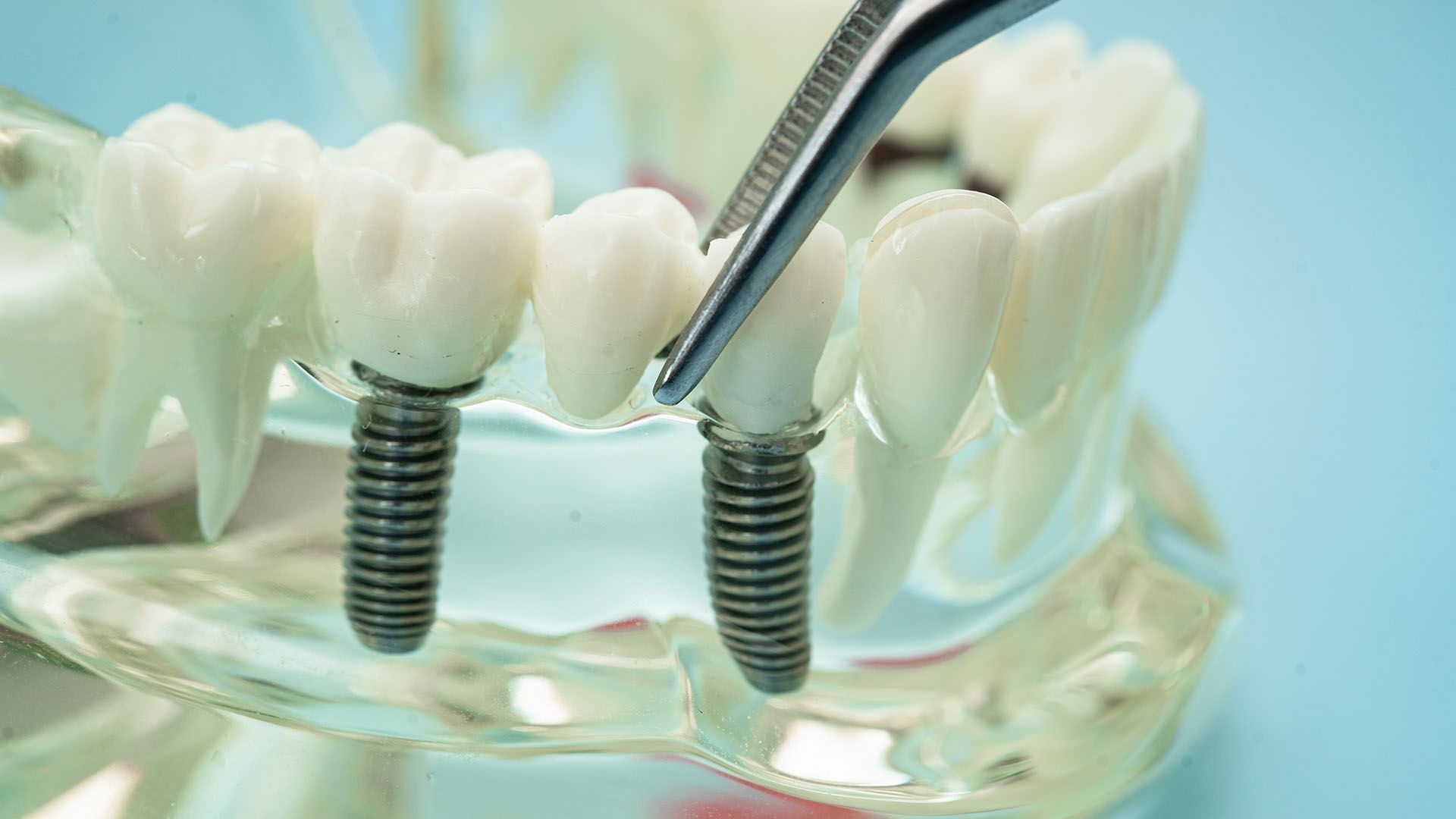 Dental implant model with a crown being held by tweezers, blue background.
