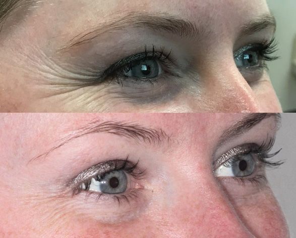 before and after botox in tucson az