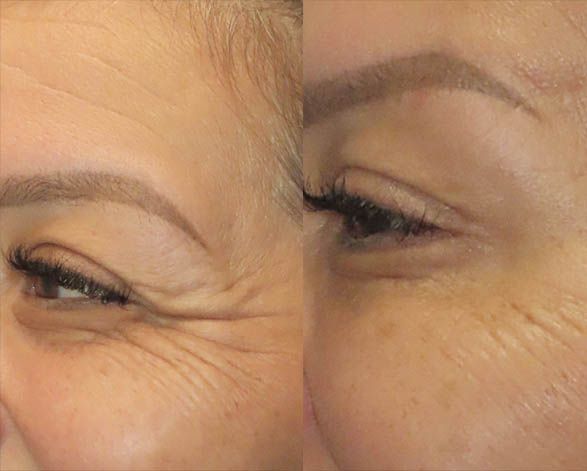 before and after botox in tucson az