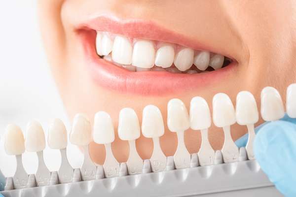 Caring for Veneers After a Cosmetic Dentist Treatment