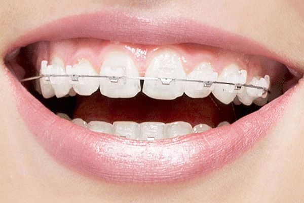 3 Things to Know About Clear Braces