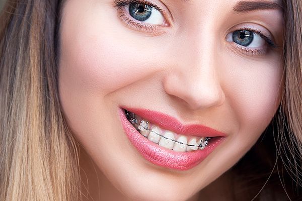 Common Clear Braces Maintenance and Aftercare
