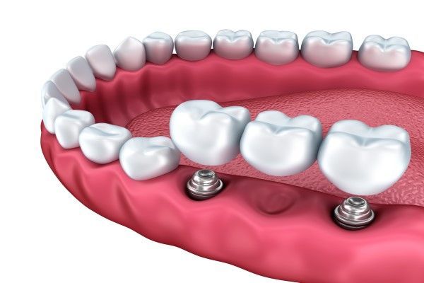 What Is an Implant Supported Bridge?