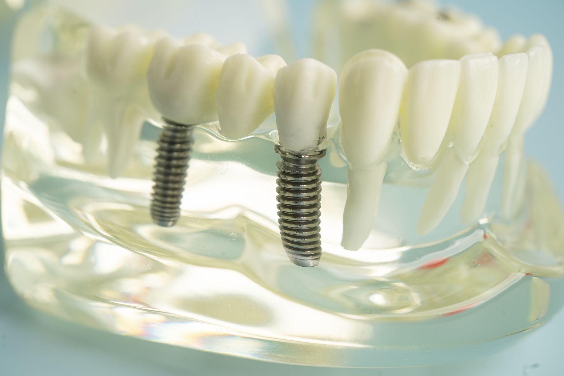 Model of dental implants in a clear jaw; white teeth attached to metal screws.