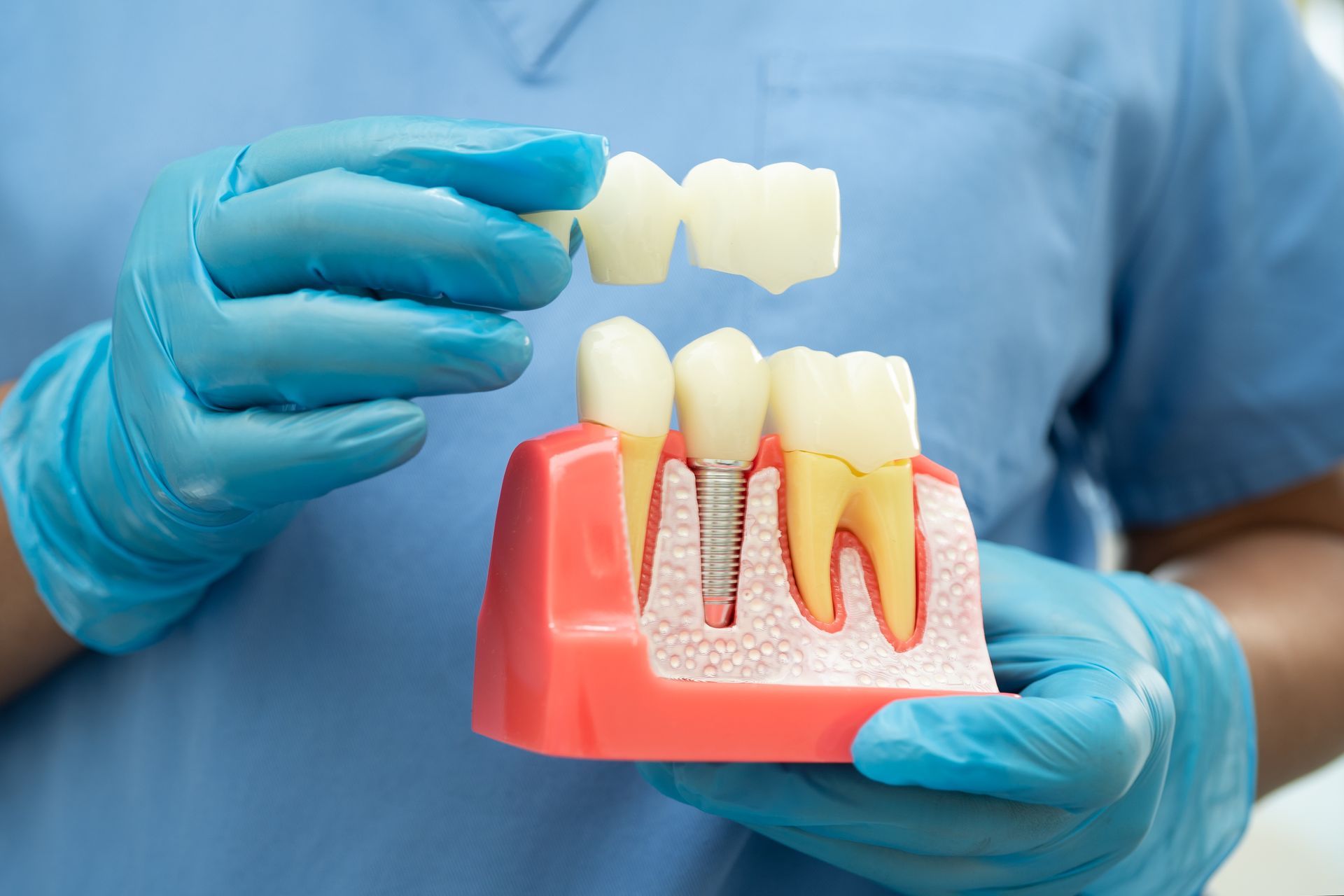 Gloved hands holding a dental implant model and tooth crown in a clinical setting