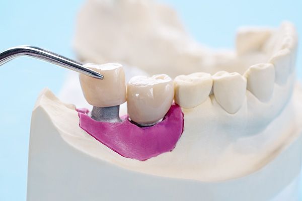 How a Dental Implants Treatment Can Improve Oral Health and Function