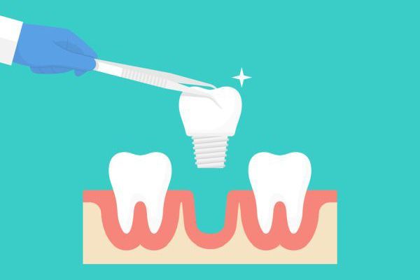 Do Dental Implants Look and Feel Like Natural Teeth?