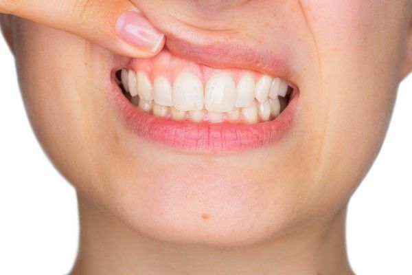Cosmetic Gum Surgery — Soft Tissue Graft
