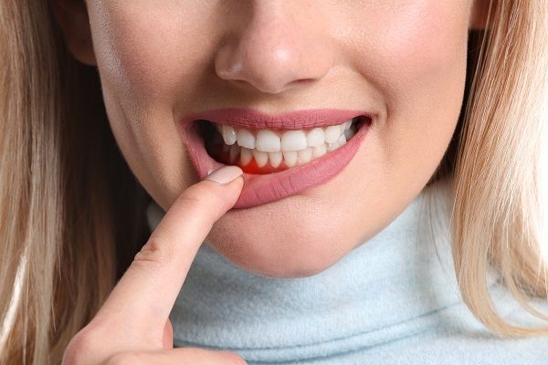 dental lip fillers in tucson az
